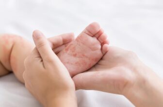 Don’t Blame Covid-19 for Recent Measles Outb...